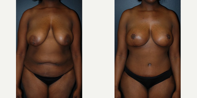 Case 526 - Woman treated with Tummy Tuck