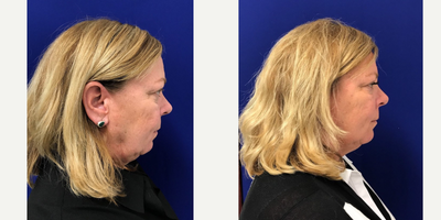 Case 5260 - 55-64 year old woman treated with Botox