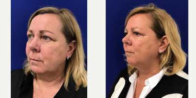 Case 5261 - 55-64 year old woman treated with Botox