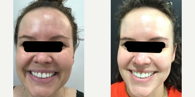 Case 5262 - 25-34 year old woman treated with Botox, Chemical Peel, HydraFacial