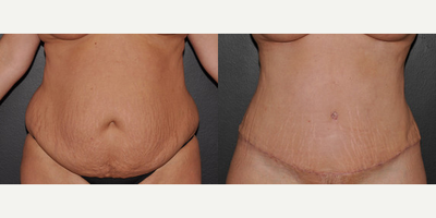 Case 527 - Woman treated with Tummy Tuck