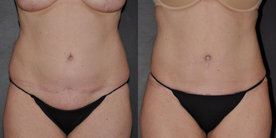 Case 528 - Woman treated with Tummy Tuck