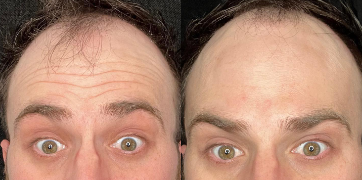 Case 5281 - Man treated with Botox