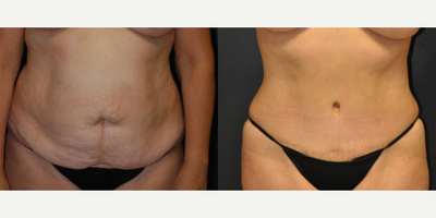 Case 529 - 45-54 year old woman treated with Tummy Tuck