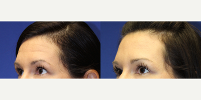 Case 5290 - 32 year old woman treated with Botox