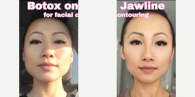 Case 5294 - Woman treated with Botox