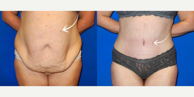 Case 53 - Woman treated with Tummy Tuck