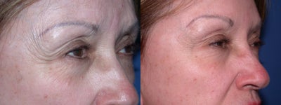 Case 5307 - Before & After Botox Treatment