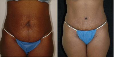 Case 540 - 25-34 year old woman treated with Tummy Tuck