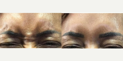 Case 5400 - 45-54 year old woman treated with Botox