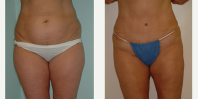 Case 541 - 25-34 year old woman treated with Tummy Tuck
