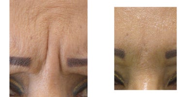Case 5414 - 45-54 year old woman treated with Botox