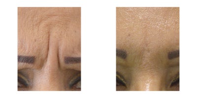 Case 5415 - Women 45 - 35 treated with Botox