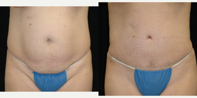 Case 542 - 25-34 year old woman treated with Tummy Tuck