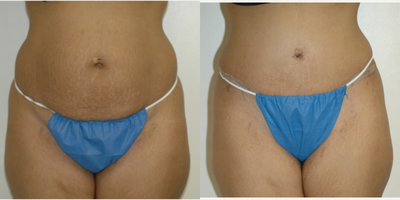Case 543 - 25-34 year old woman treated with Tummy Tuck