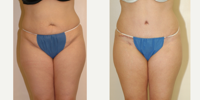 Case 544 - 25-34 year old woman treated with Tummy Tuck