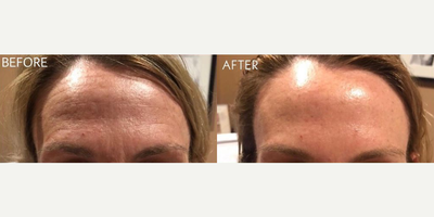 Case 5440 - Woman treated with Botox