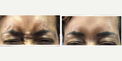 Case 5441 - 45-54 year old woman treated with Botox