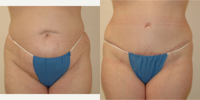 Case 545 - 35-44 year old woman treated with Tummy Tuck