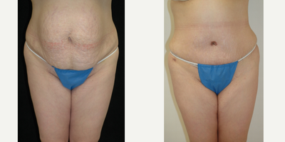 Case 546 - 25-34 year old woman treated with Tummy Tuck