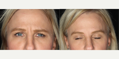 Case 5460 - 35-44 year old woman treated with Botox