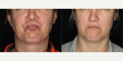 Case 5462 - 35-44 year old woman treated with Botox
