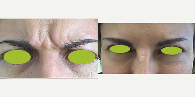 Case 5465 - 35-44 year old woman treated with Botox