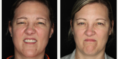 Case 5466 - 35-44 year old woman treated with Botox