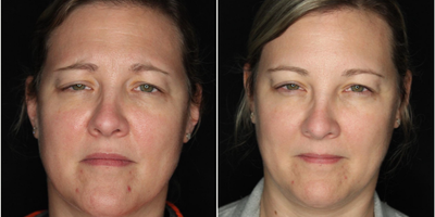 Case 5467 - 35-44 year old woman treated with Botox