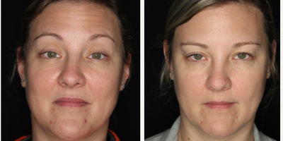 Case 5468 - 35-44 year old woman treated with Botox