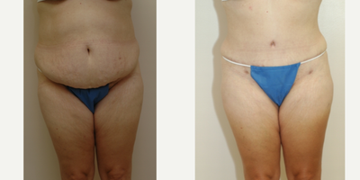 Case 547 - 35-44 year old woman treated with Tummy Tuck