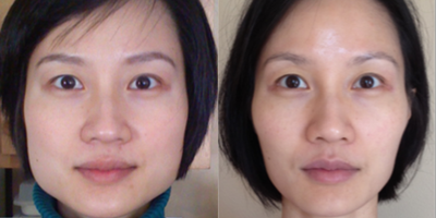 Case 5475 - 35 yo woman treated with Botox for facial slimming