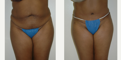 Case 548 - 25-34 year old woman treated with Tummy Tuck