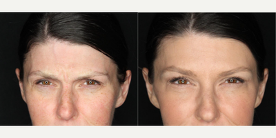 Case 5486 - 35-44 year old woman treated with Botox