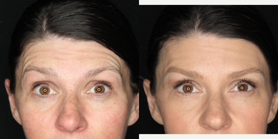 Case 5487 - 35-44 year old woman treated with Botox