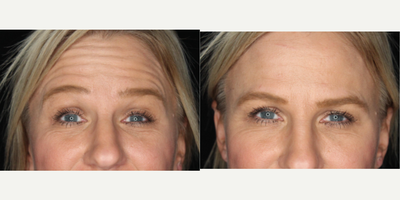 Case 5488 - 35-44 year old woman treated with Botox