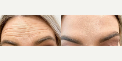 Case 5489 - Woman treated with Botox