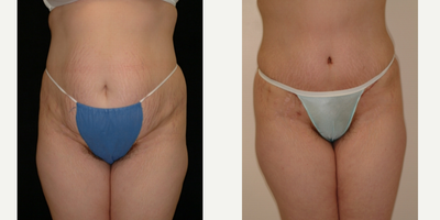 Case 549 - 25-34 year old woman treated with Tummy Tuck