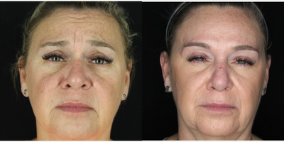 Case 5490 - 45-54 year old woman treated with Botox