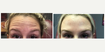 Case 5495 - 25-34 year old woman treated with Botox