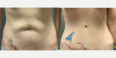 Case 55 - Woman treated with Tummy Tuck