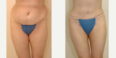 Case 550 - 35-44 year old woman treated with Tummy Tuck