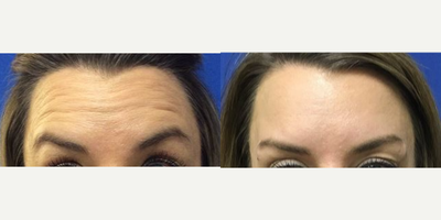 Case 5505 - 25-34 year old woman treated with Botox