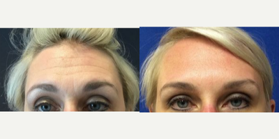 Case 5506 - 35-44 year old woman treated with Botox