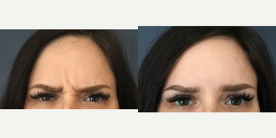 Case 5507 - 35-44 year old woman treated with Botox