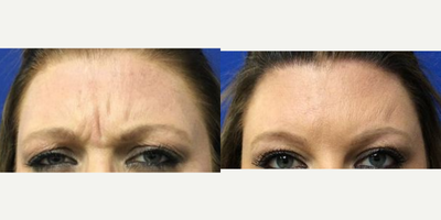 Case 5508 - 35-44 year old woman treated with Botox