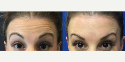 Case 5509 - 25-34 year old woman treated with Botox