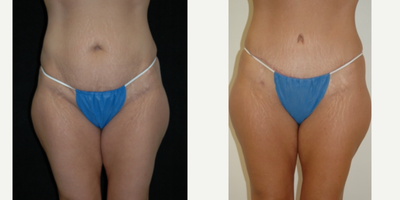 Case 551 - 25-34 year old woman treated with Tummy Tuck