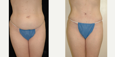 Case 552 - 35-44 year old woman treated with Tummy Tuck