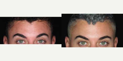 Case 5522 - 25-34 year old man treated with Botox